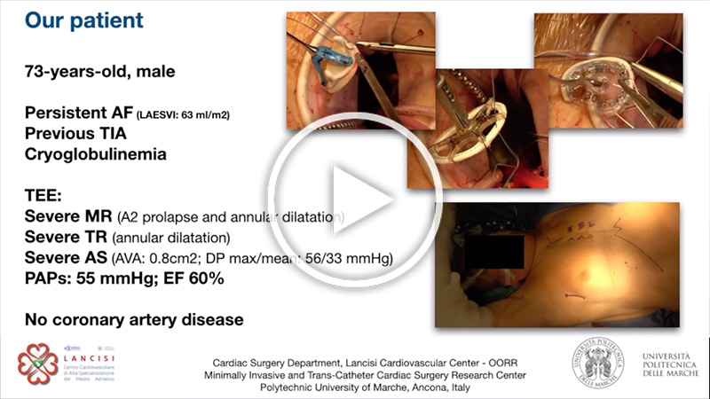 https://www.minicardiacsurgery-univpm-research.com/wp-content/uploads/2021/05/26-Trans-Axillary-Triple-Valve-Surgery.jpg