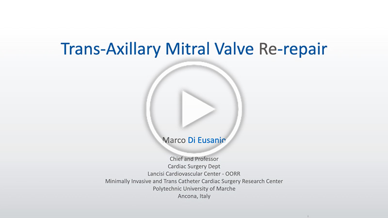 https://www.minicardiacsurgery-univpm-research.com/wp-content/uploads/2021/07/28-Trans-axillary-Mitral-Valve-Re-repair.jpg