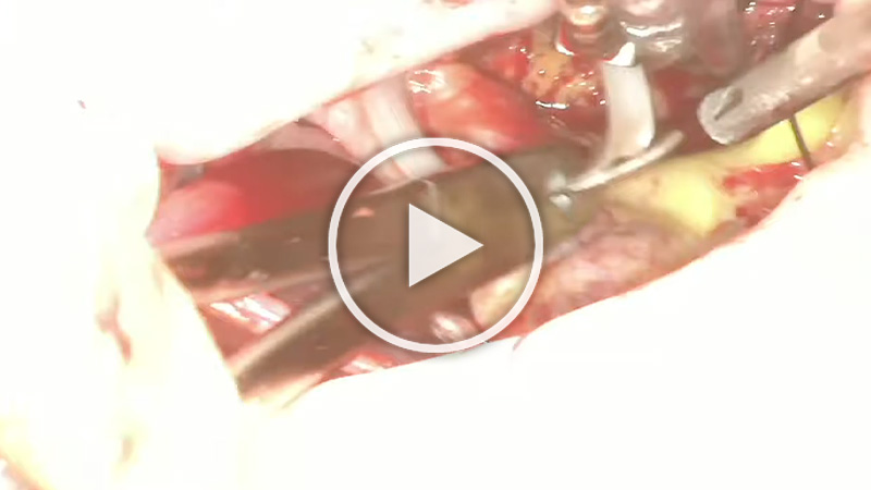 https://www.minicardiacsurgery-univpm-research.com/wp-content/uploads/2021/07/29-Transaxillary-direct-view-LAA-closure.jpg