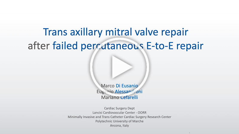 https://www.minicardiacsurgery-univpm-research.com/wp-content/uploads/2021/08/31-Trans-axillary-mitral-valve-repair-after-failed-percutenous-edge-to-edge-repair.jpg