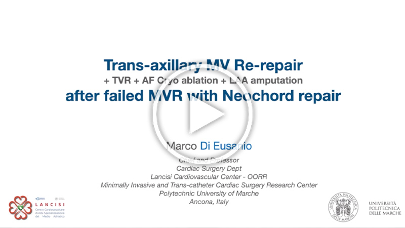 https://www.minicardiacsurgery-univpm-research.com/wp-content/uploads/2022/02/38-Trans-axillary-MV-re-repair-after-failed-Trans-apical-Neochord-epair.jpg
