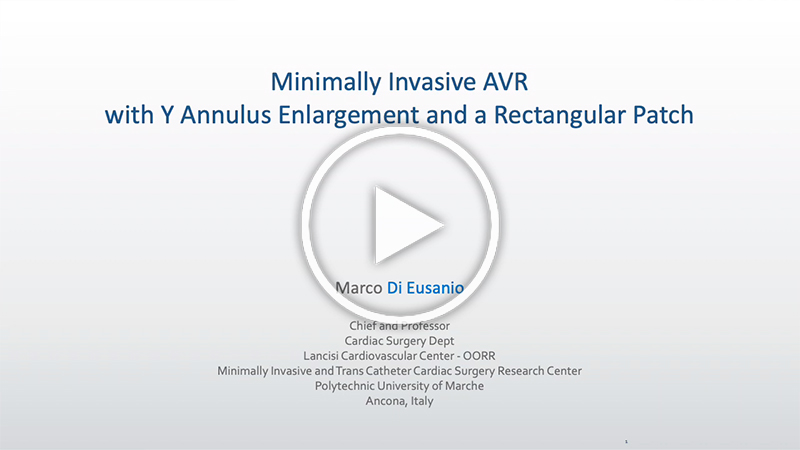 https://www.minicardiacsurgery-univpm-research.com/wp-content/uploads/2022/05/40-mini-AVR-with-Y-aortic-annulus-enlargement-and-rectangular-patch.jpg