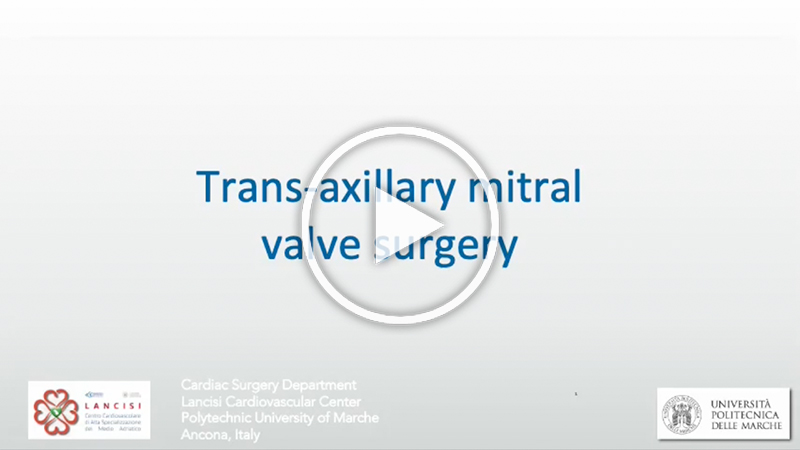 https://www.minicardiacsurgery-univpm-research.com/wp-content/uploads/2023/02/42-step-by-step-transaxillary-direct-view-MVR.jpg
