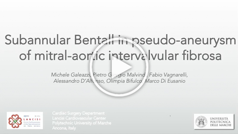 https://www.minicardiacsurgery-univpm-research.com/wp-content/uploads/2023/02/43-Subannular-Bentall-in-pseudo-aneurysm-of-mitral-aortic-intervalvular-fibrosa.jpg