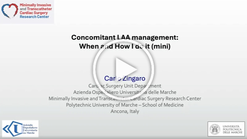 https://www.minicardiacsurgery-univpm-research.com/wp-content/uploads/2025/11/video-Concomitant-LAA-management-when-and-how-I-do-it.jpg