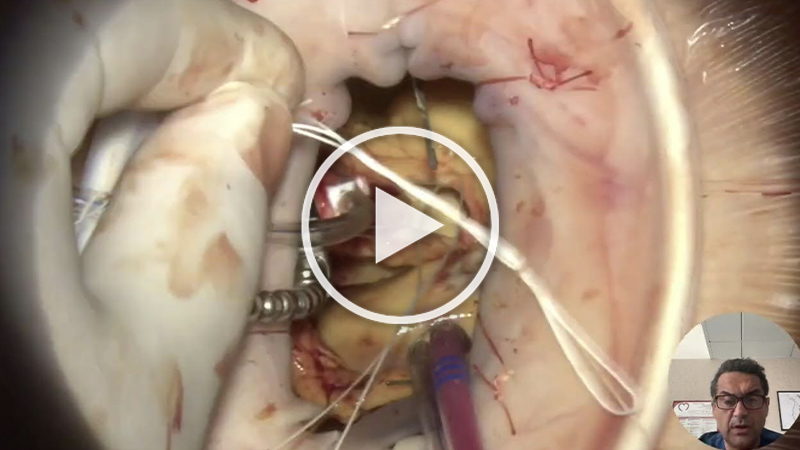 https://www.minicardiacsurgery-univpm-research.com/wp-content/uploads/2025/11/video-Transaxillary-AVR-with-Intuity-Elite.jpg