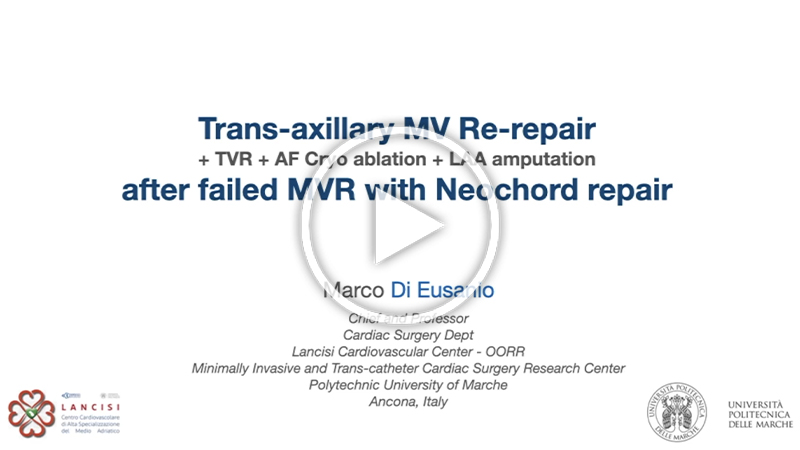 https://www.minicardiacsurgery-univpm-research.com/wp-content/uploads/2025/11/video-•-Transaxillary-MVR-after-failed-trans-apical-Neochord-repair.jpg